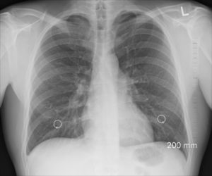 Medical misdiagnosis compensation claim. Specialist solicitors. X ray Image 